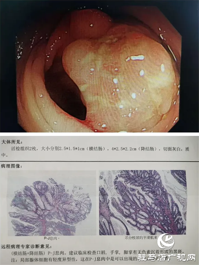 “黑痣”長(zhǎng)在嘴上，息肉生在腸內(nèi)！市中心醫(yī)院專家為一罕見(jiàn)病患者內(nèi)鏡下切除30多處腸道腫物