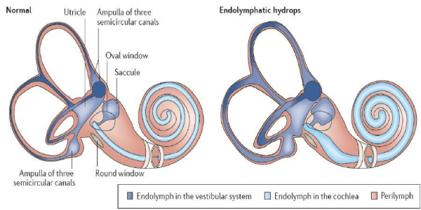 “耳水不平衡”是什么病？